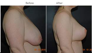 Breast Reduction NYC Case 1070