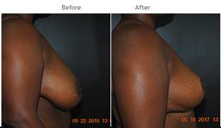 Breast Reduction NYC Case 1071
