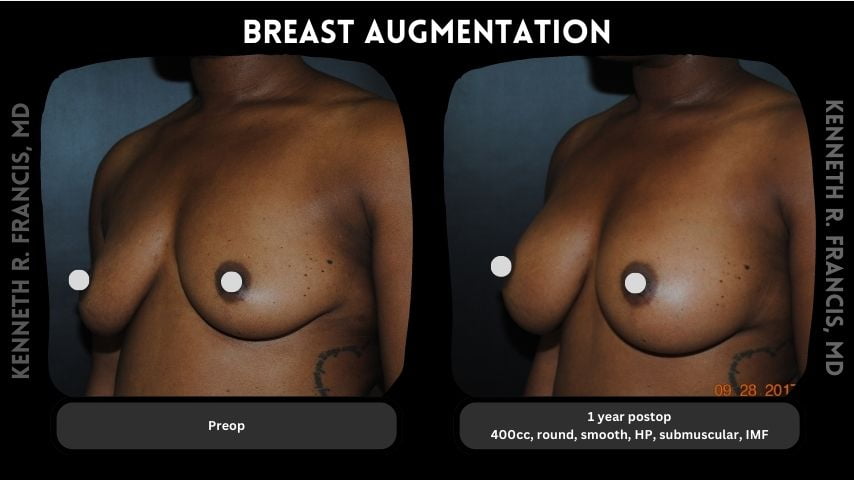 Breast augmentation 10