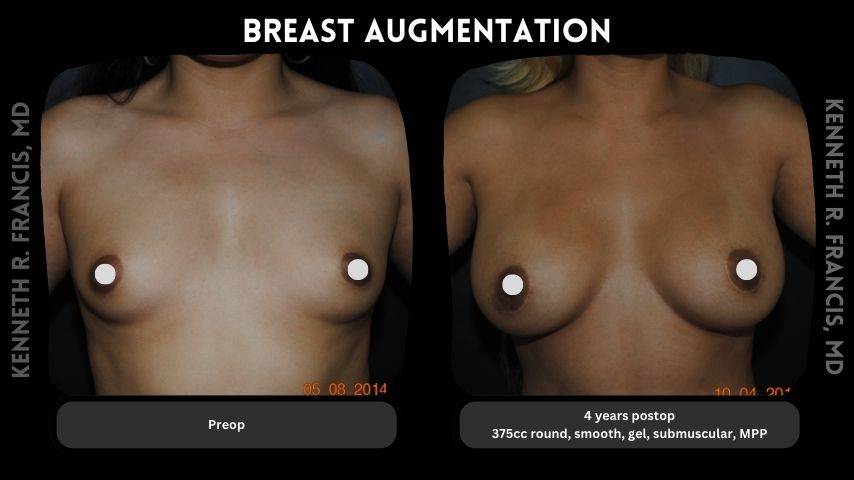 Breast augmentation 5