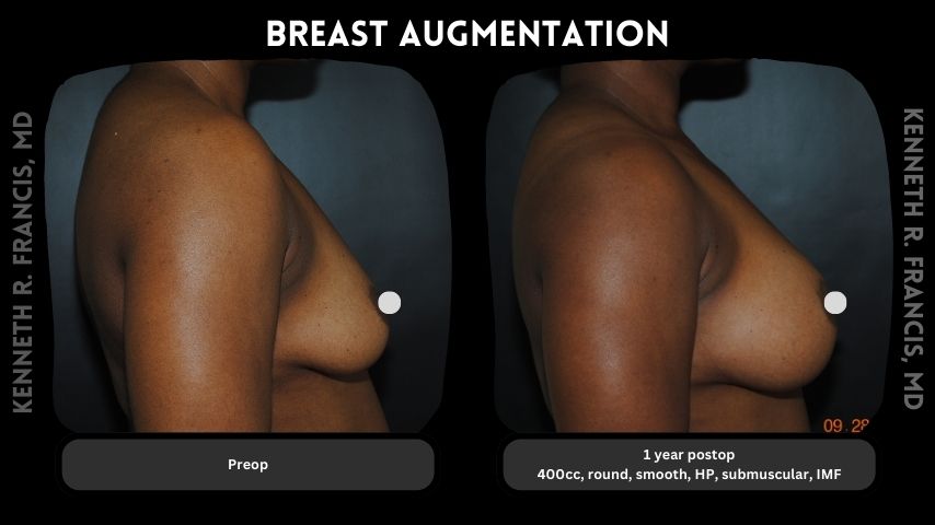 Breast augmentation 8