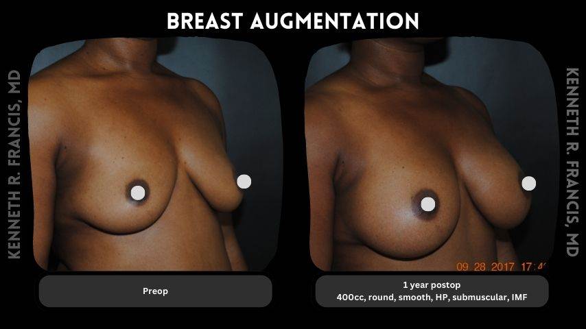 Breast augmentation 9