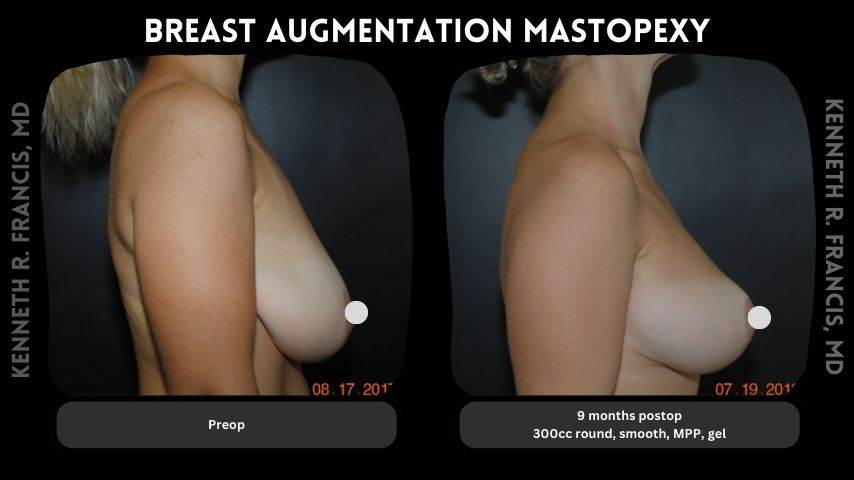 Breast augmentation mastopexy 1