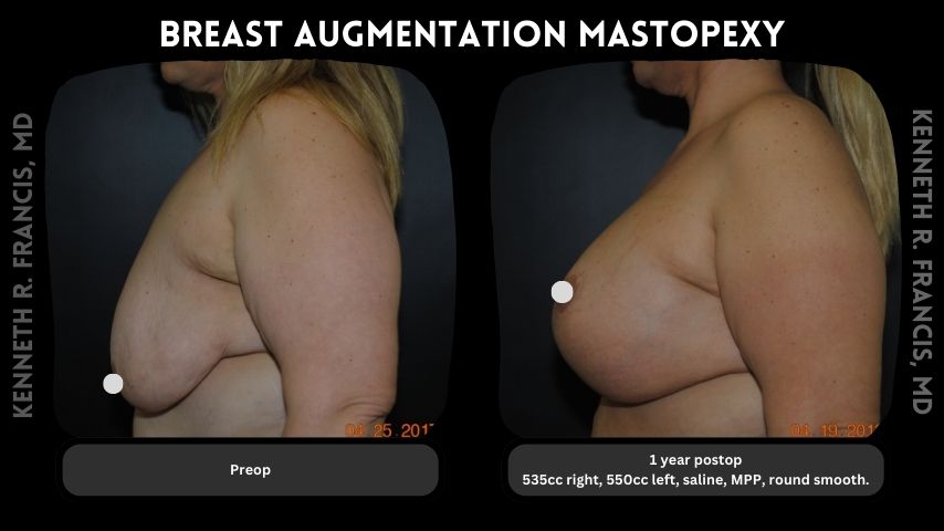 Breast augmentation mastopexy 4