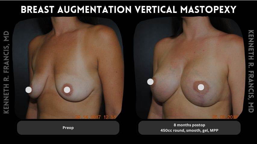 Breast augmentation vertical mastopexy 1