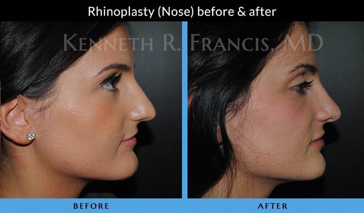 Rhinoplasty (Nose) before and after