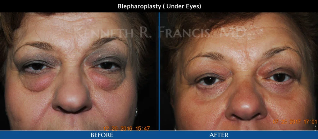 Blepharoplasty ( Under Eyes) Plastic Surgeons Manhattan, Nyc