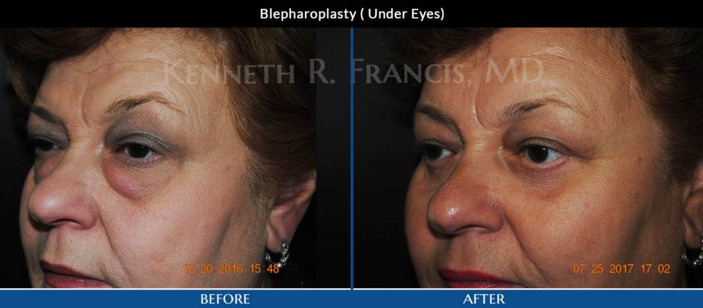 before after blepharoplasty2 tag 1 Kenneth R. Francis, MD - New York, NY
