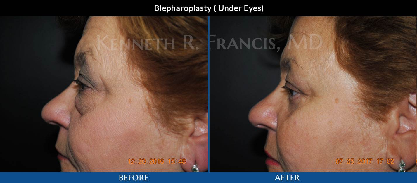 Blepharoplasty (Eyelid) before & after 3 Blepharoplasty (Eyelid) NYC