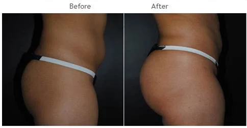 Buttocks Augmentation