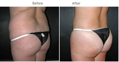 Brazilian butt lift in New York City