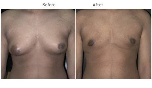 Gynecomastia