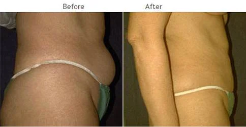 Liposuction Nyc Procedure - Laser Lipo New York City