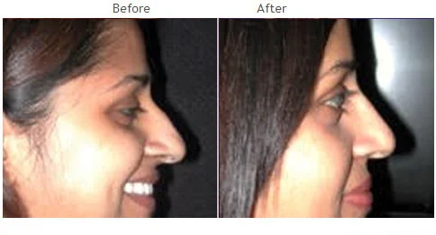 Rhinoplasty (Nose) Before And After