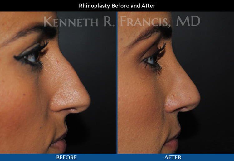 Plastic Surgeon NYC Manhattan NY, Kenneth R. Francis, MD