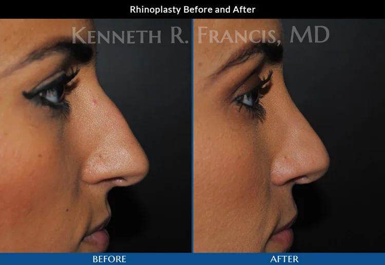 Rhinoplasty (Nose) Before And After