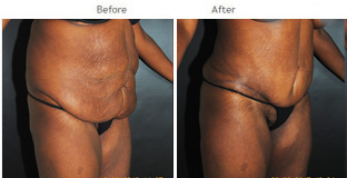 Liposuction New York City - Laser Lipo Patient 1022