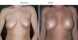 Breast Augmentation NYC Case 1055