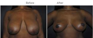 Breast Reduction NYC Case 1067