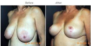 Breast Reduction NYC Case 1068
