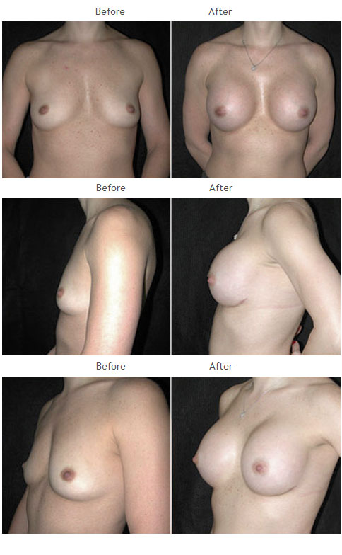 Breast Augmentation NYC Case 1051