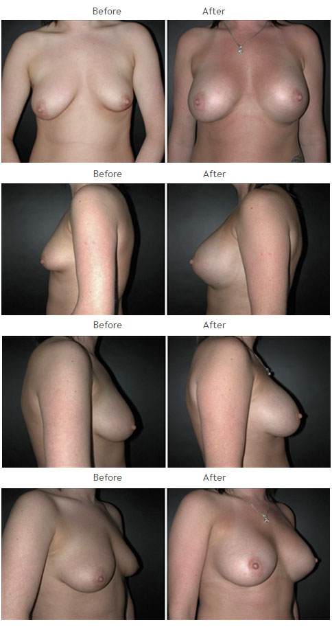 Breast Augmentation NYC Case 1055