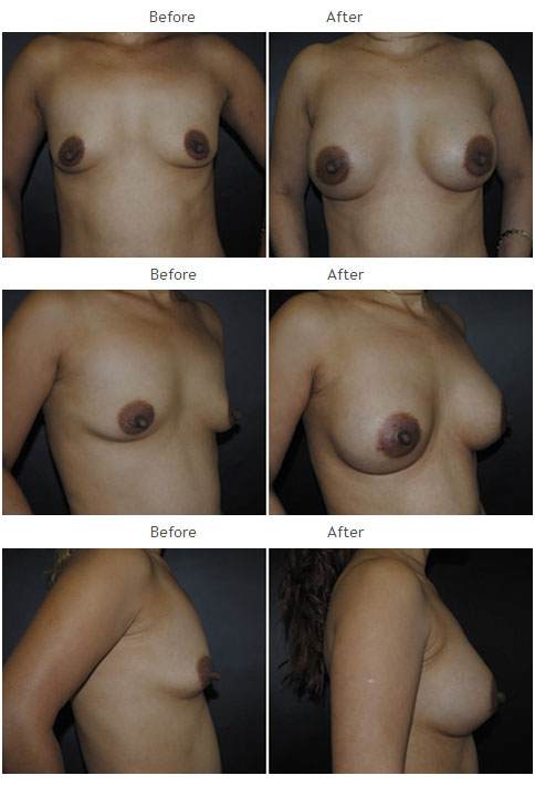 Breast Augmentation NYC Case 1062