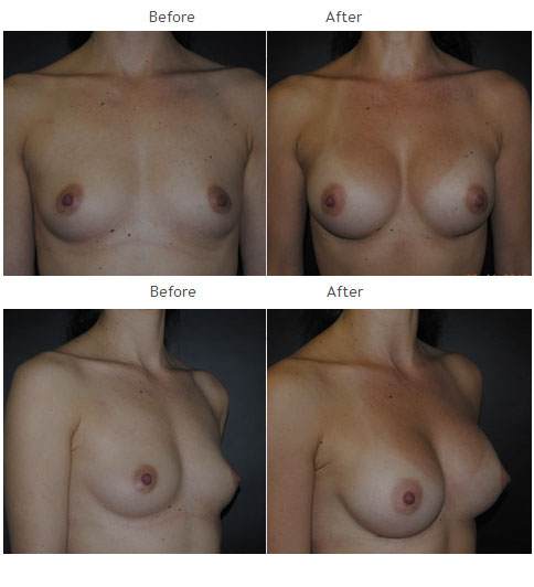 Breast Augmentation NYC Case 1063