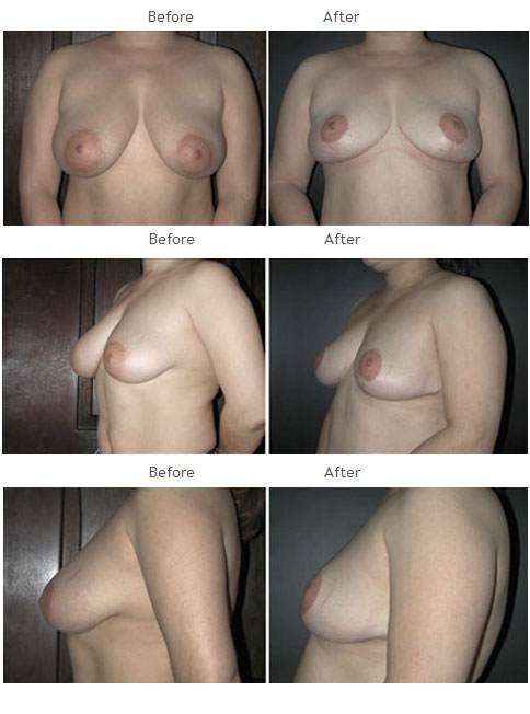 Breast Reduction NYC Case 1065