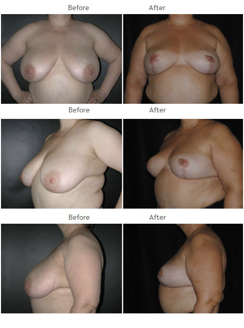 Breast Reduction NYC Case 1066