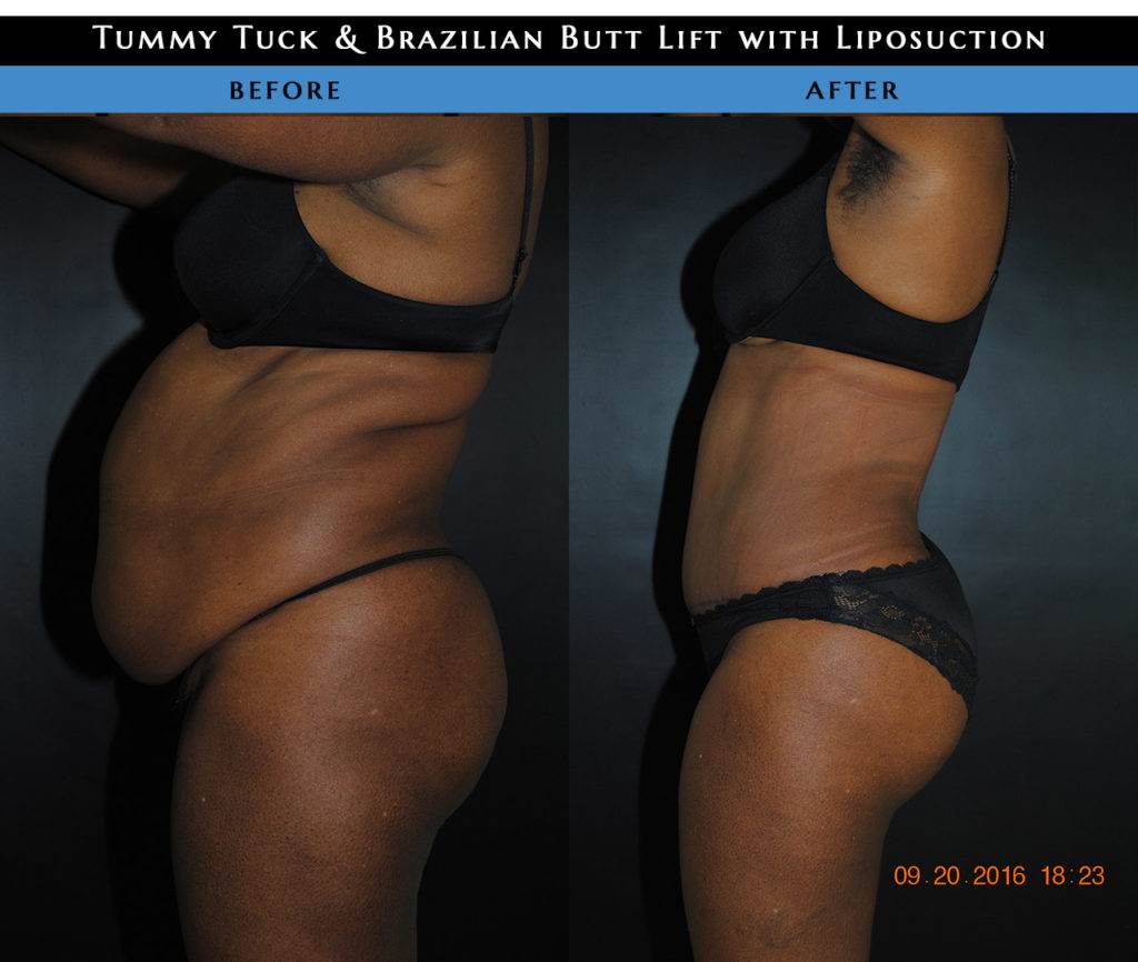 Tummytuck, Brazilian butt lift, liposuction, NYC