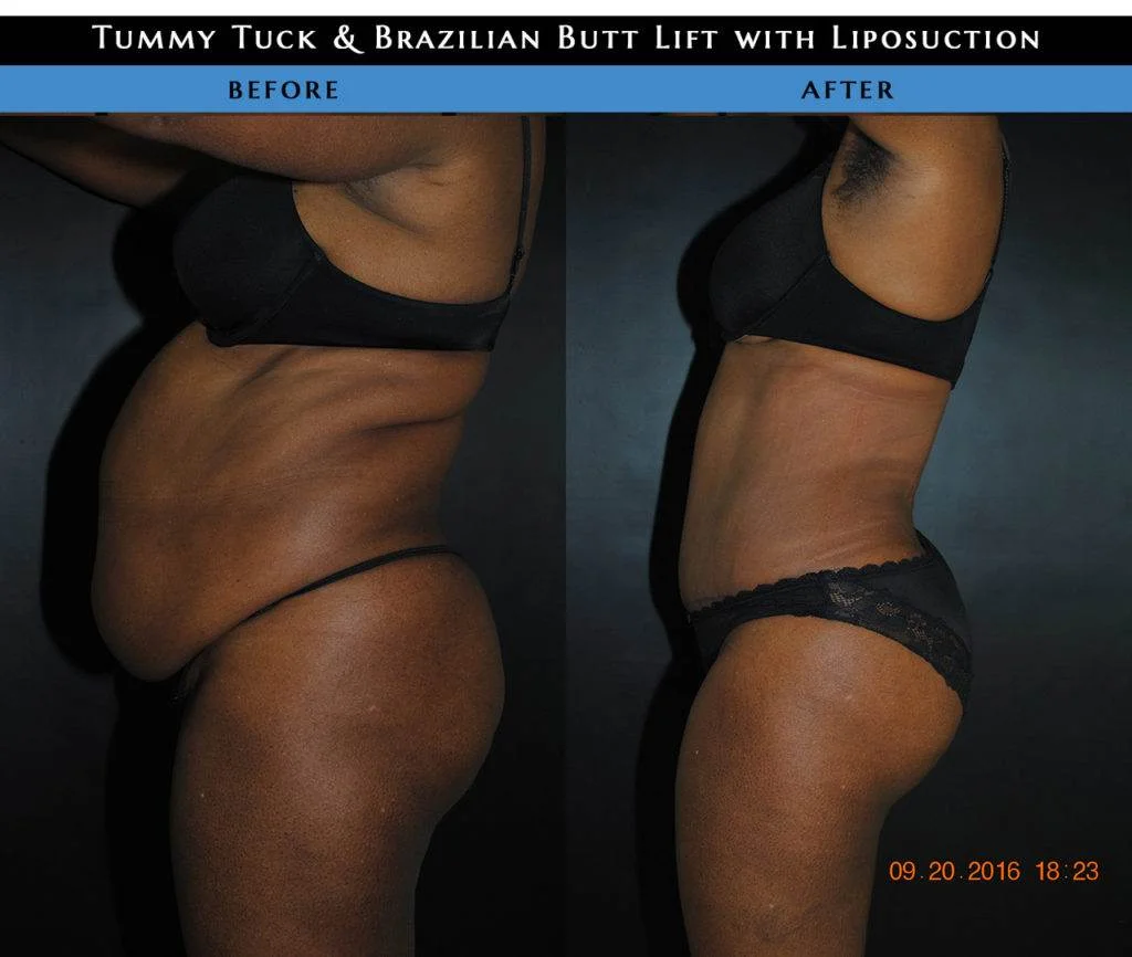 Tummy Tuck NYC (abdominoplasty)
