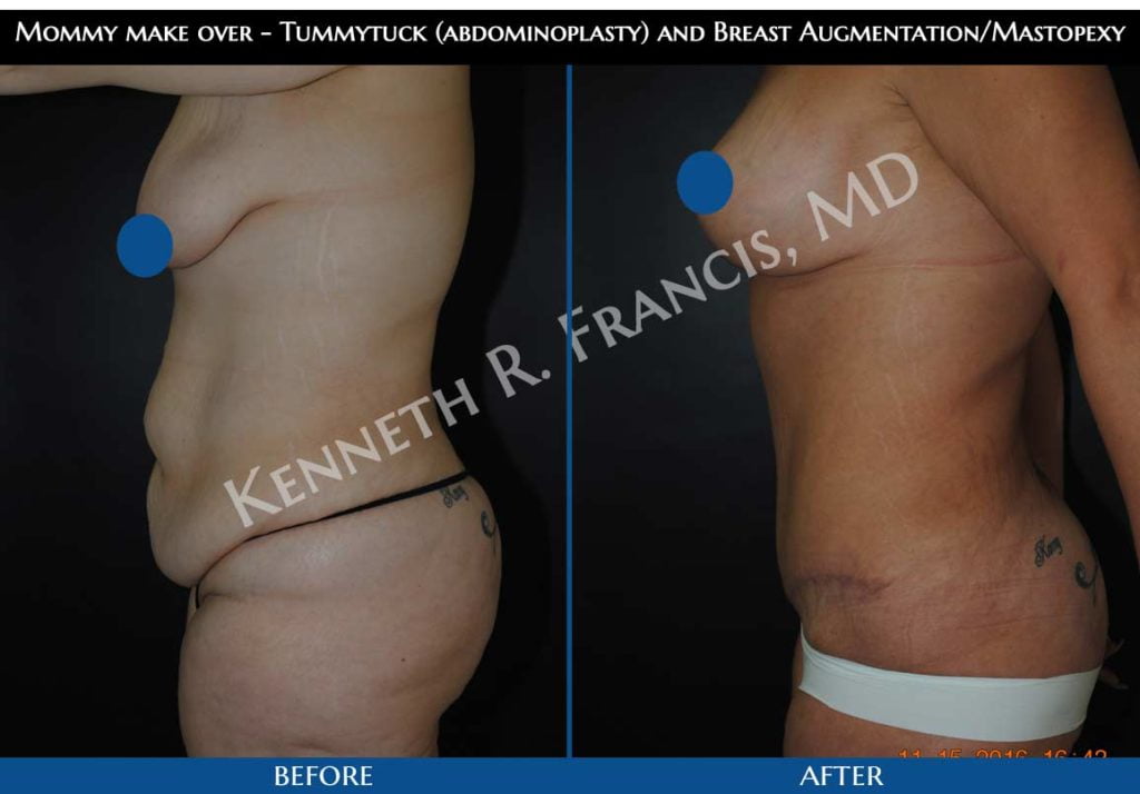 Mommy make over - Tummytuck (abdominoplasty) and Breast Augmentation/Mastopexy