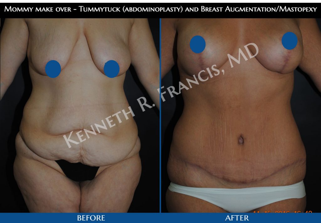 Mommy make over - Tummytuck (abdominoplasty) and Breast Augmentation/Mastopexy