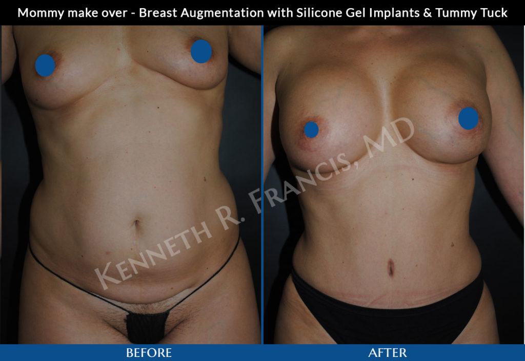 Mommy make over - Breast Augmentation with Silicone Gel Implants & Tummy Tuck