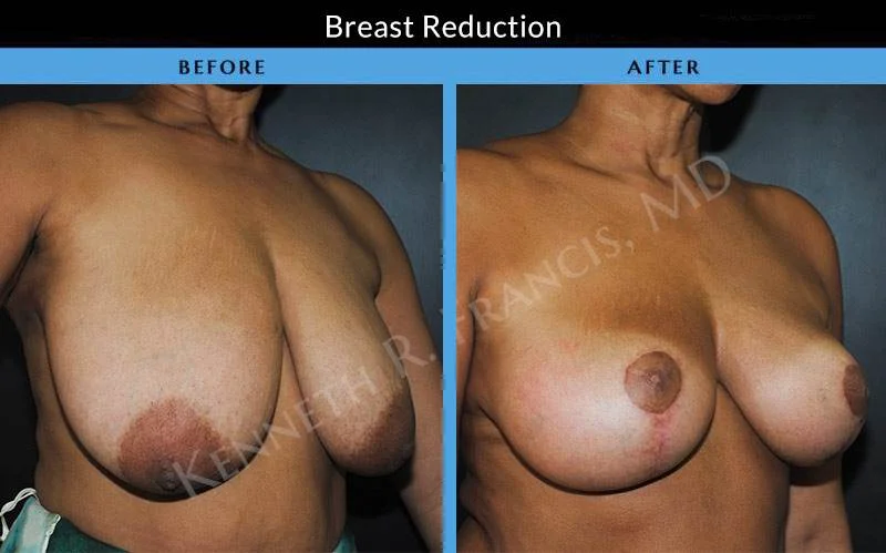 Breast Reduction Before After