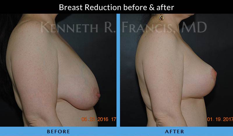 Breast Reduction before after 1070