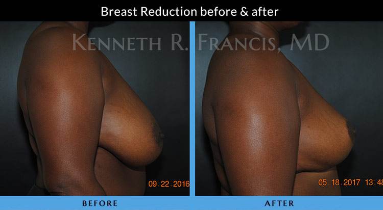 Breast Reduction NYC Case 1071