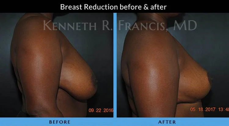 Breast Reduction Nyc Case 1071
