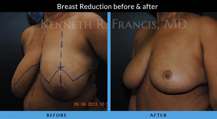 Breast Reduction NYC Case 1072