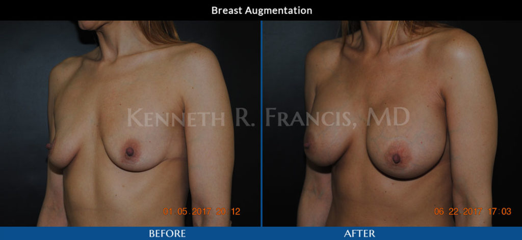 breast augmentation before and after in Manhattan NYC