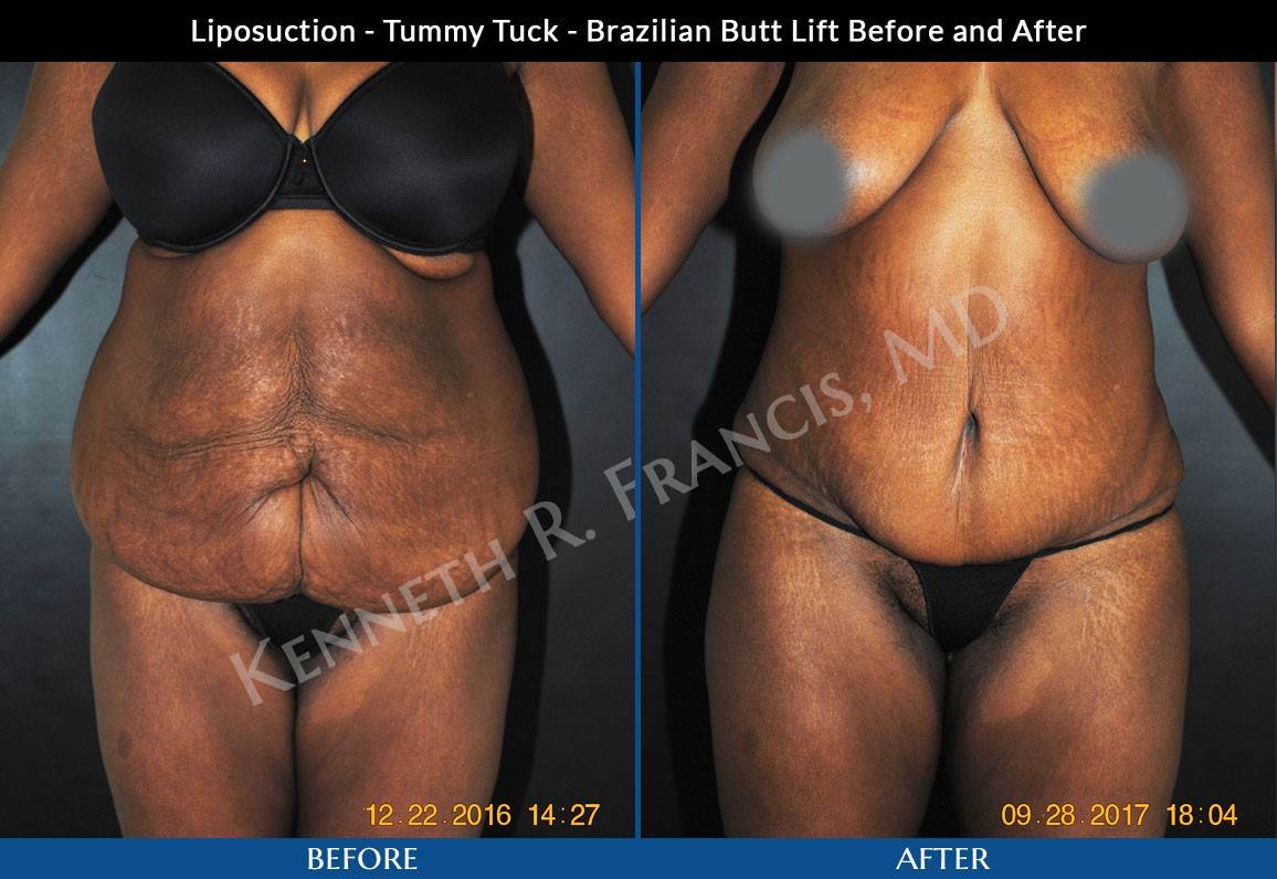 Liposuction NYC Case 1022