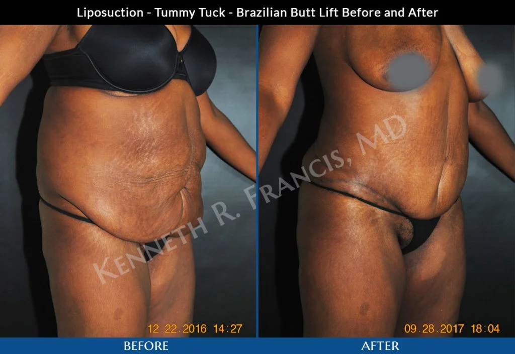 Liposuction, Brazilian Butt Lift, Tummy Tuck Nyc