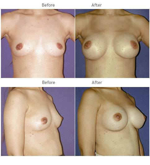 breast augmentation NYC