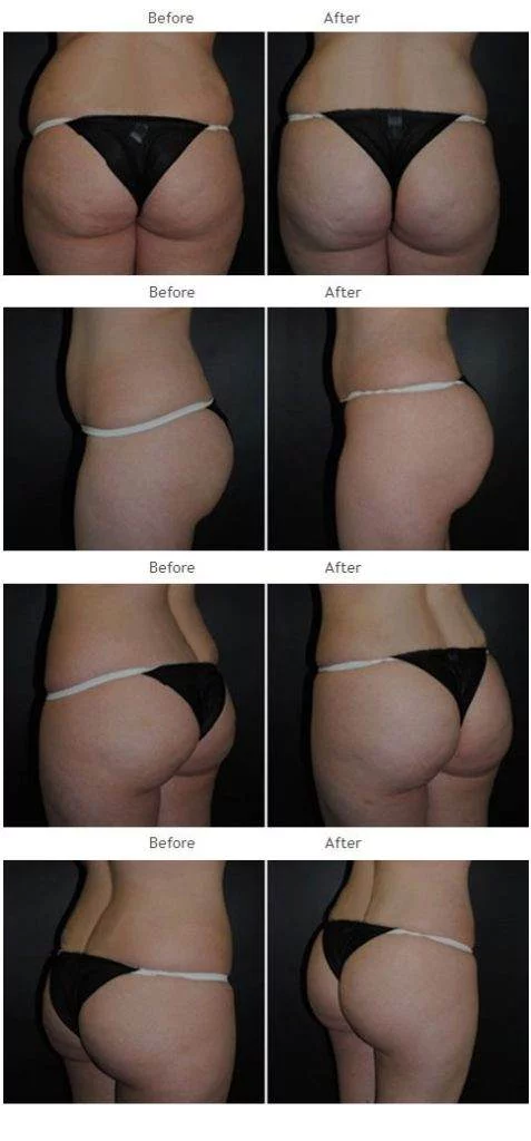 Brazilian Butt Lift Before And After Brazilian Butt Lift Before And After