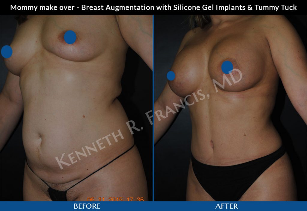 breast implants nyc 1