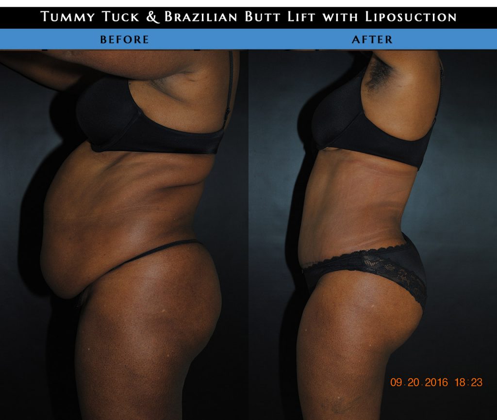 liposuction nyc 1