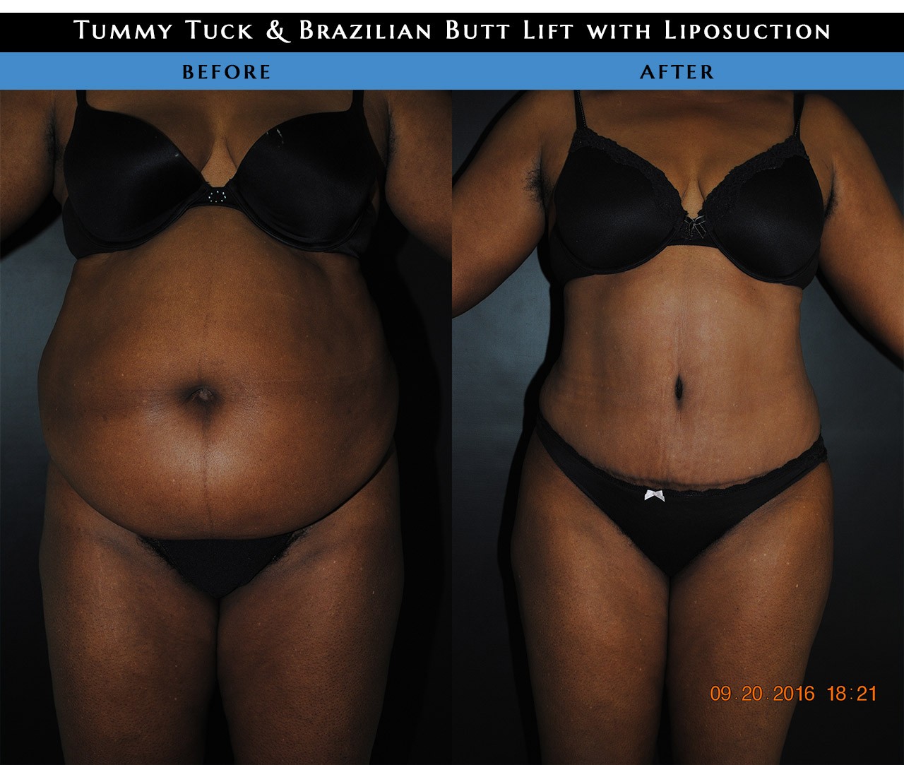 tummytuck liposuction before after1