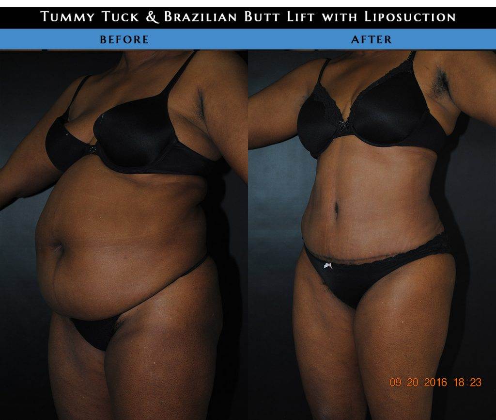 tummytuck liposuction before after2