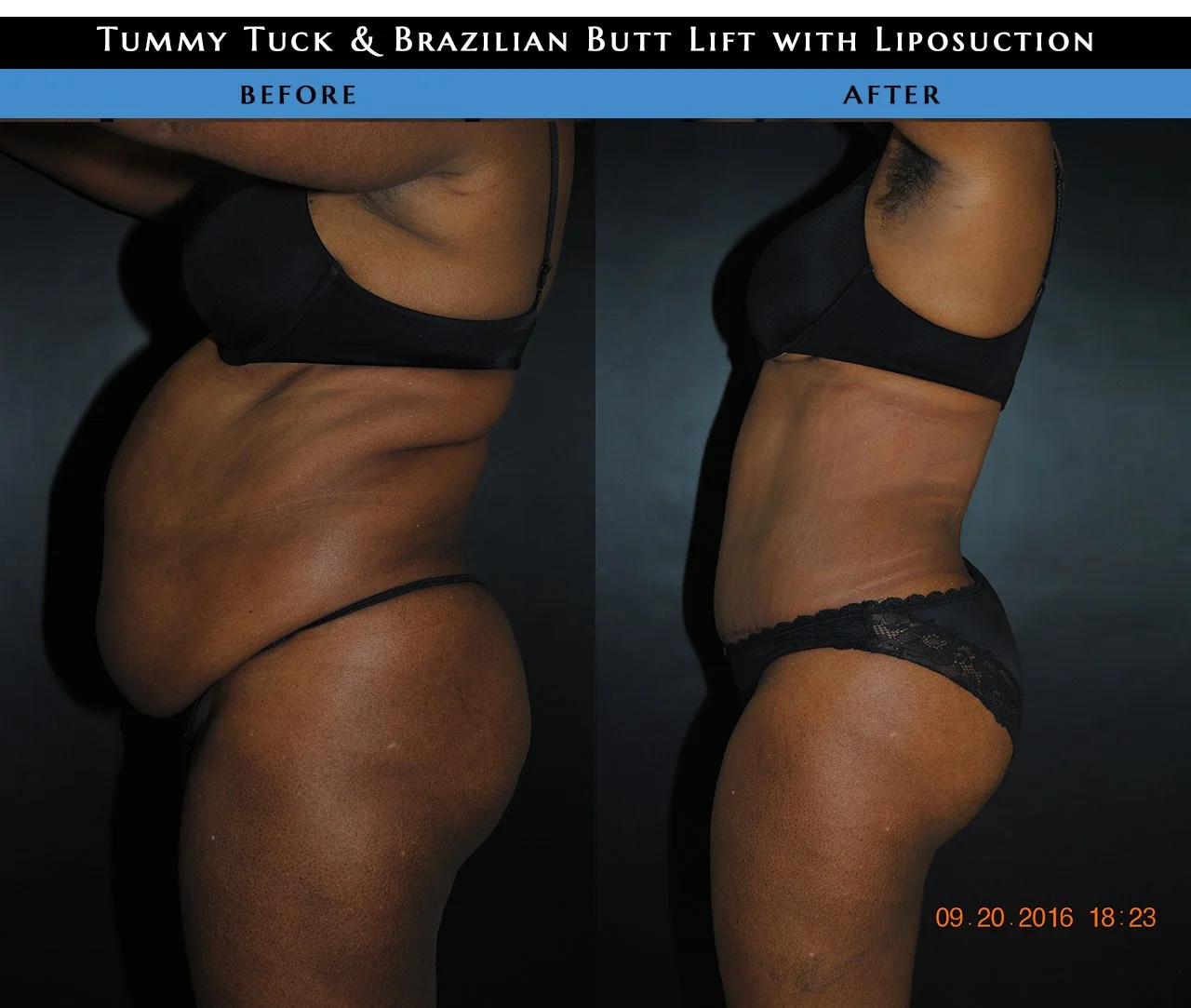 Plus size tummy tuck 3 Plus size tummy tuck Plus size tummy tuck